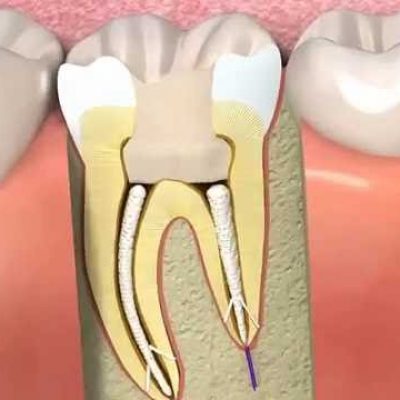 endodontie-devitalisation-dents-biodental-dentiste-paris