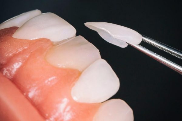 pose-facette-dentaire-biodental-cabinet-dentiste-paris-saint-lazare